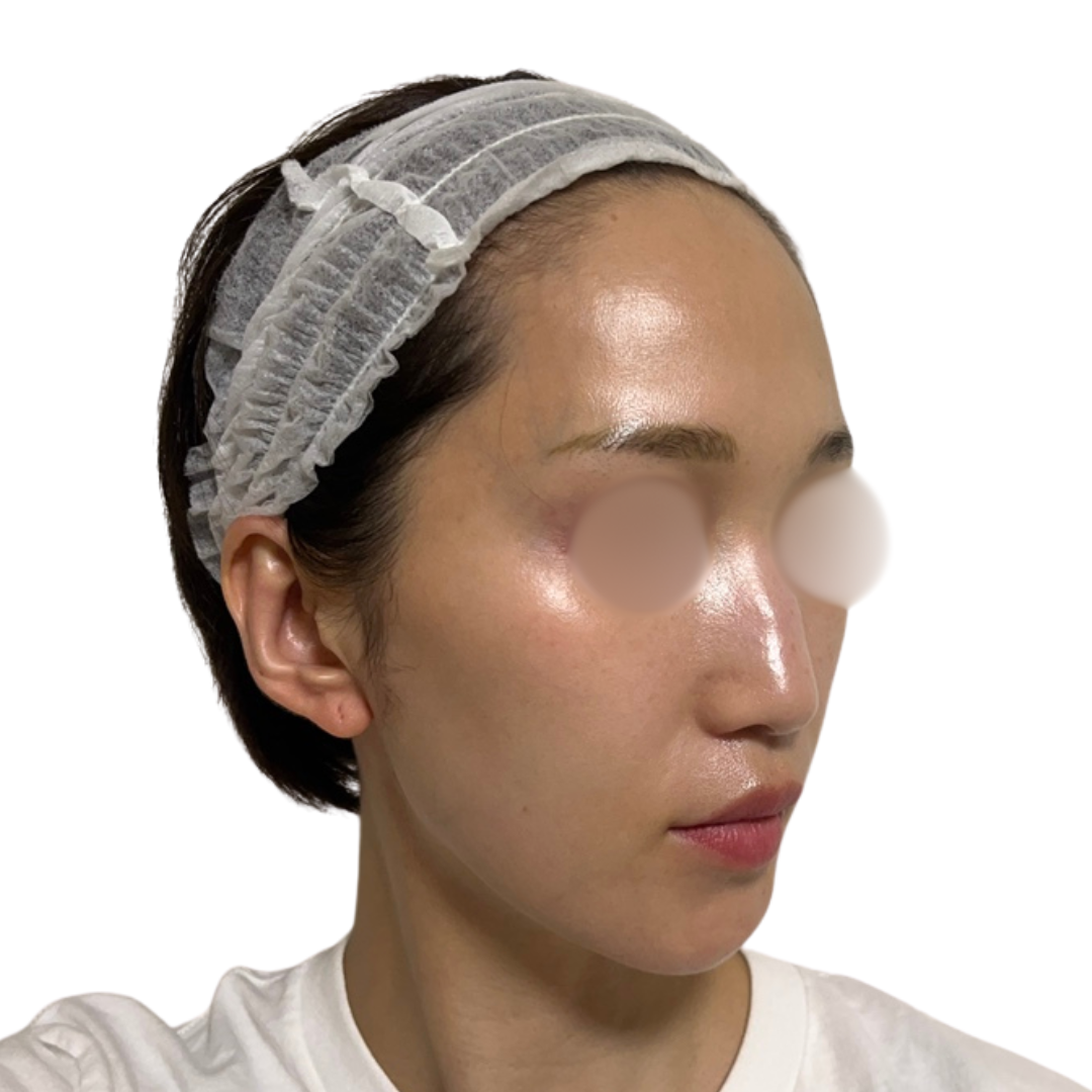 ピコフォーカス（ピコトーニング＋ピコフラクショナル）